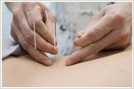 Acupuncture needles being punctured in skin